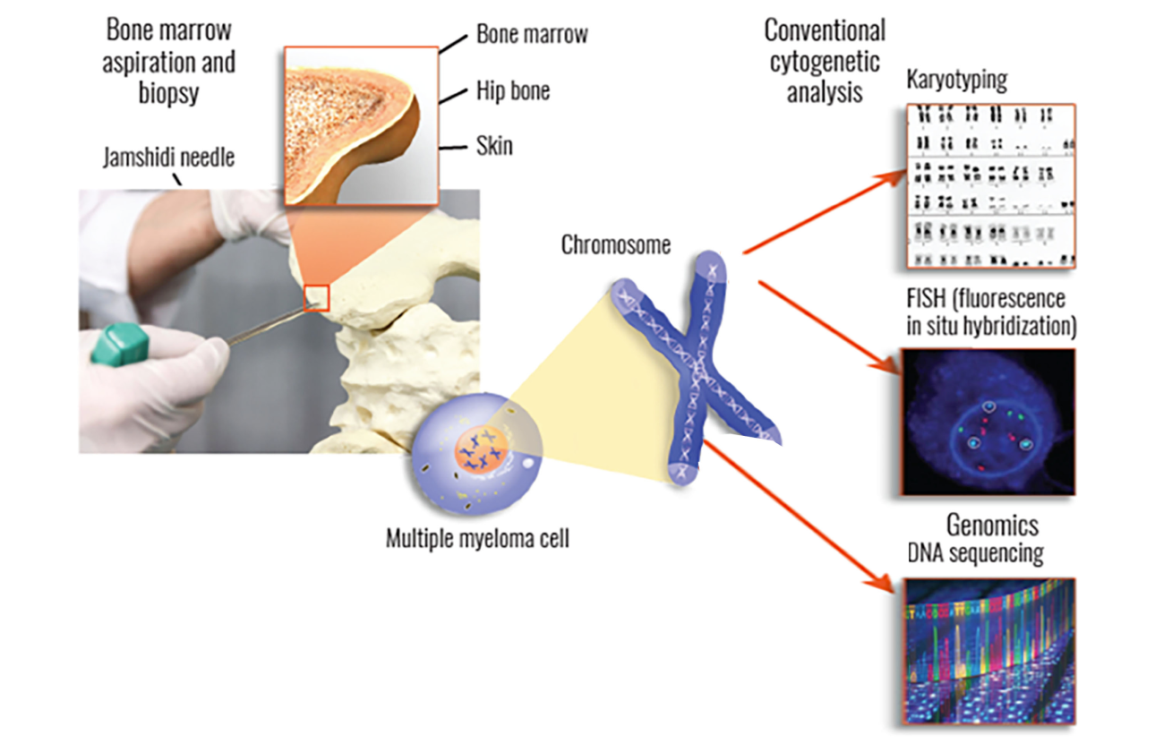 Bone marrow aspiration and biopsy diagram showing components of bone and multiple myeloma cells.